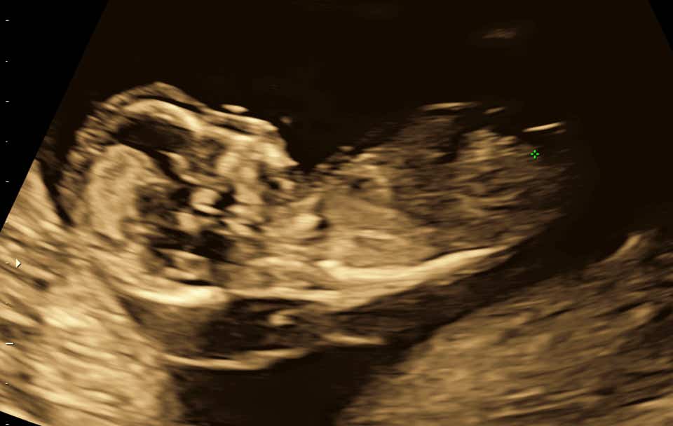 Embryo mit verbreiterter Nackentransparenz