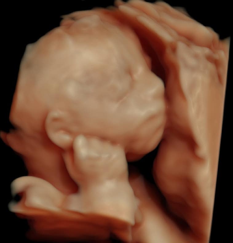 Fetus mit Hand am Ohr in der 25. SSW