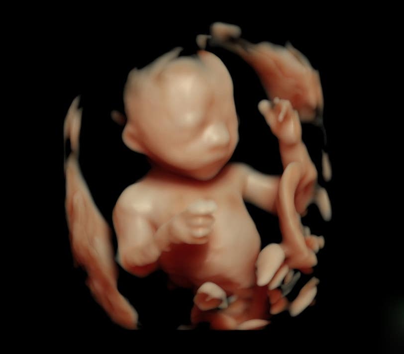 Fetus in der 23. SSW mit viel Platz durch zuviel Fruchtwasser