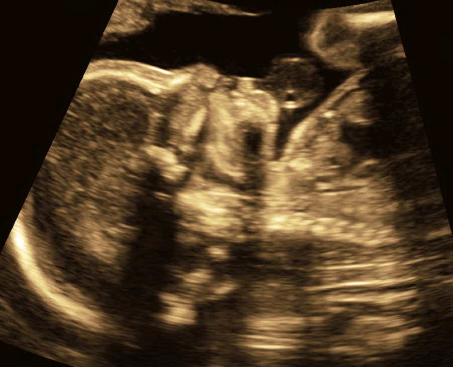 Auffälliges fetales Profil in der 21. SSW